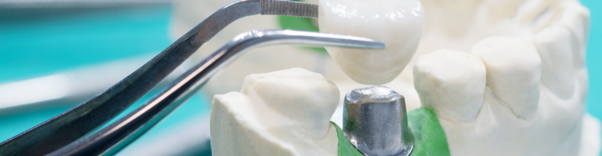 A dental crown being placed on an implant.